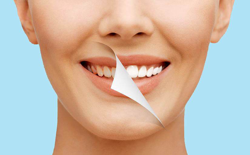 Ways to whiten teeth