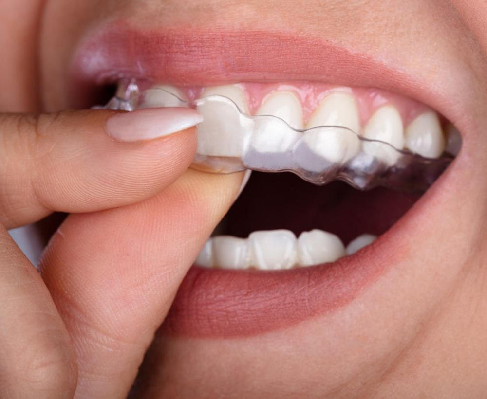 Αόρατοι Νάρθηκες Δοντιών Invisalign