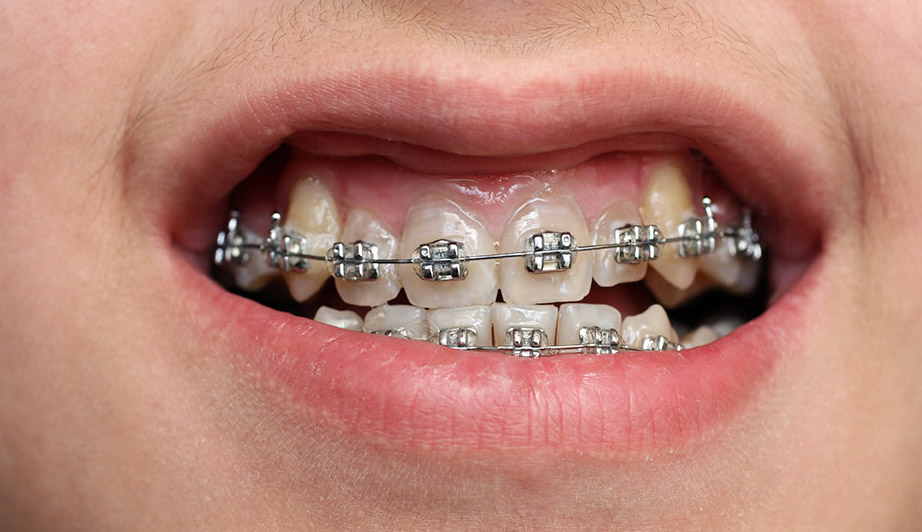 Orthodontic accidents