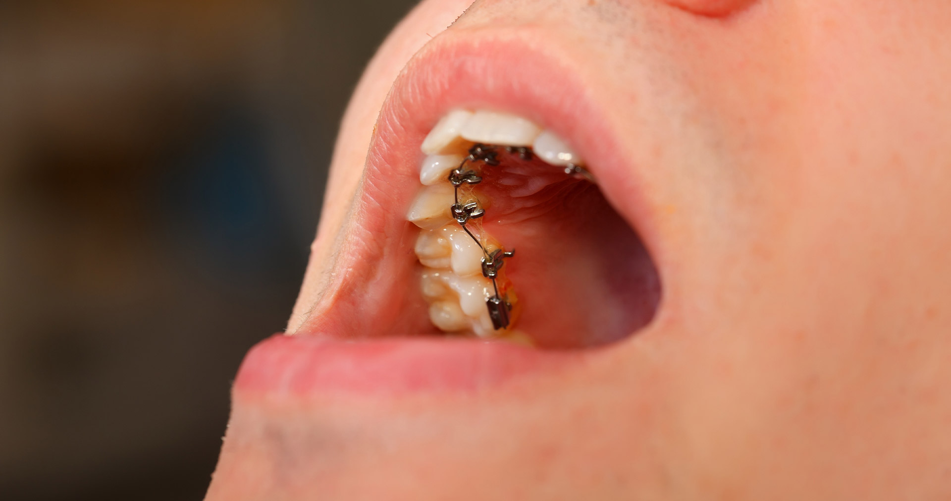 Lingual hidden braces