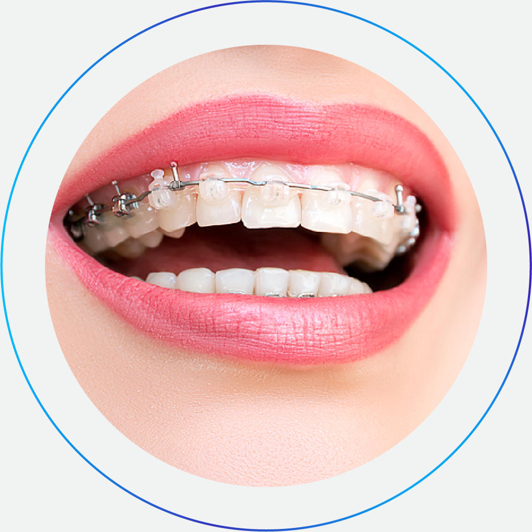 Ορθοδοντικός Invisalign Χαλάνδρι