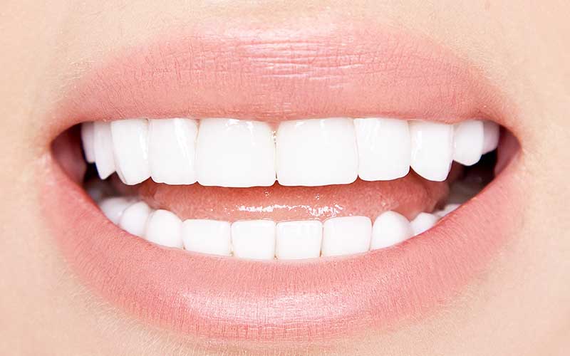 Porcelain veneers